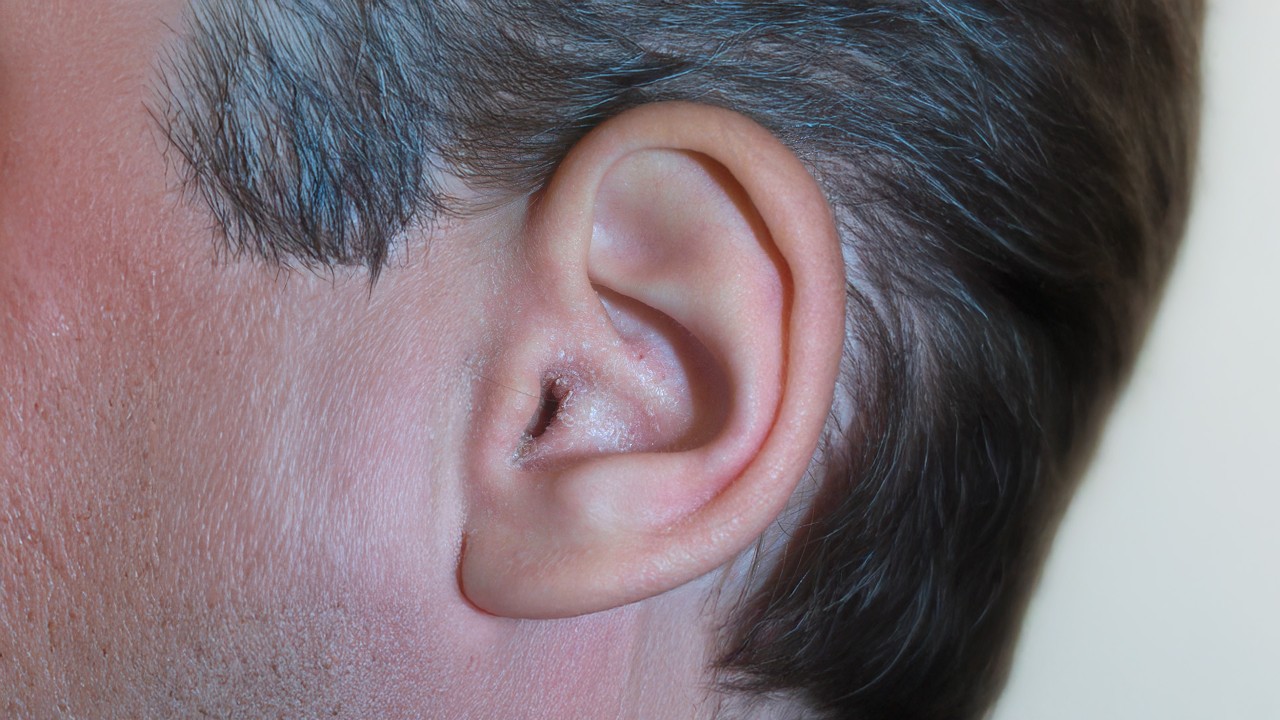 Ear psoriasis