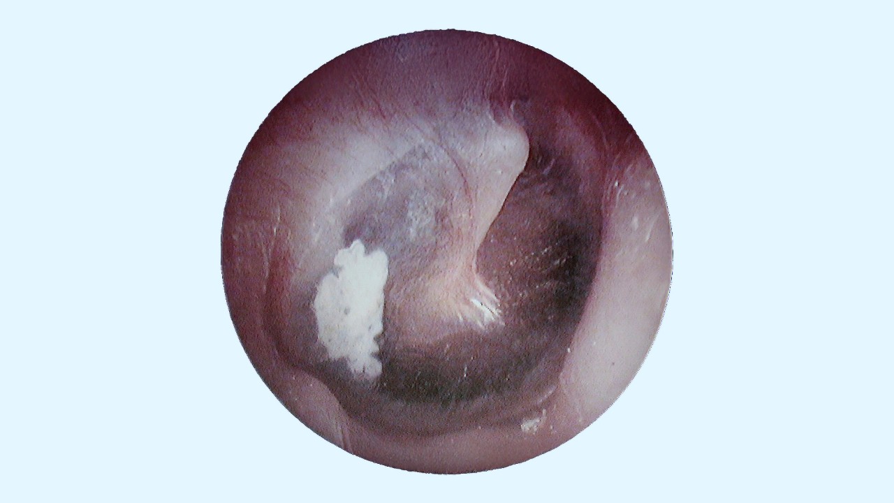 Whitish plaques in the ear canal
